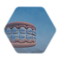 Brace dentures